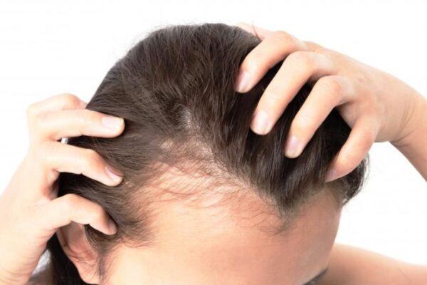 Why Hair Cloning Is The New Solution to Manage Hair Loss?